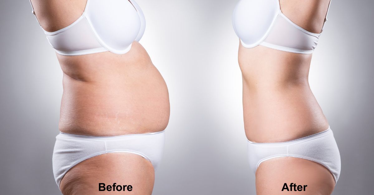 Mega Liposuction, a body contouring procedure by Dr Vinay Jacob